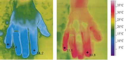 hands after-Raynaud's Syndrome